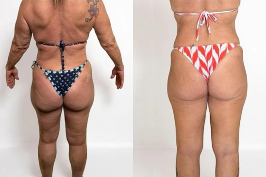 antes-e-depois-1